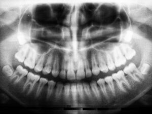 radiografia denti